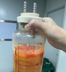 利津水动力吸脂手术要做多久？
